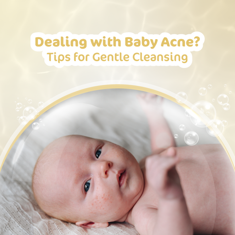 Dealing With Baby Acne? Tips For Gentle Cleansing